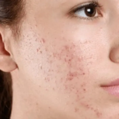 Acne-Prone Skin