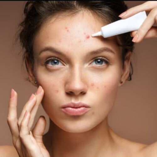 acne treatment